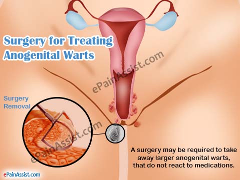Number S. reccomend Anal warts surgery recovery