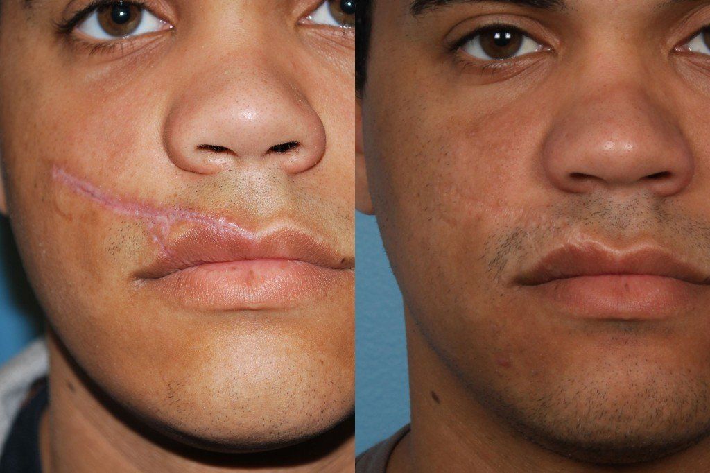 Facial scar plastic surgery