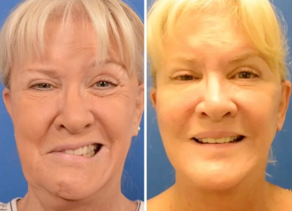 best of Clinic washington paralysis Facial state in