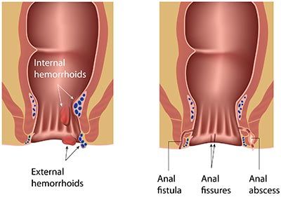 Male rectal pain anus