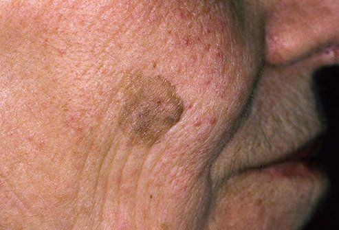 Aqua reccomend Facial skin patches