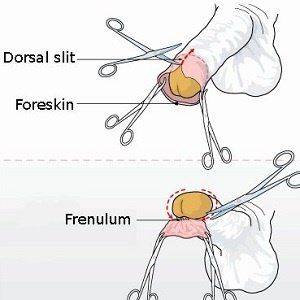 Adult circumcision technique
