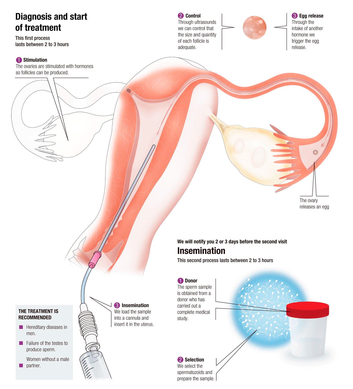 Artificial insemination sperm