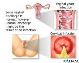 Vaginal infection after sex