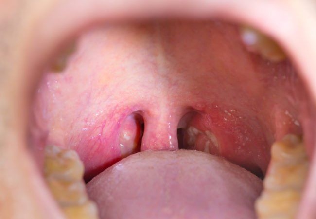Oral sex three days before getting strep throat