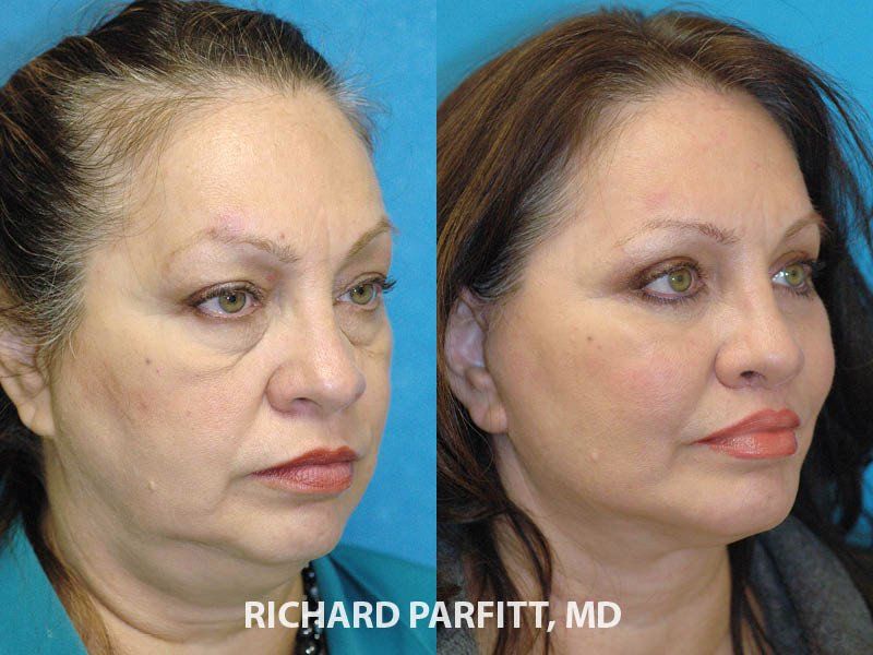 best of Facial surgery Compare