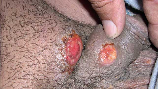 Bumps on vagina std
