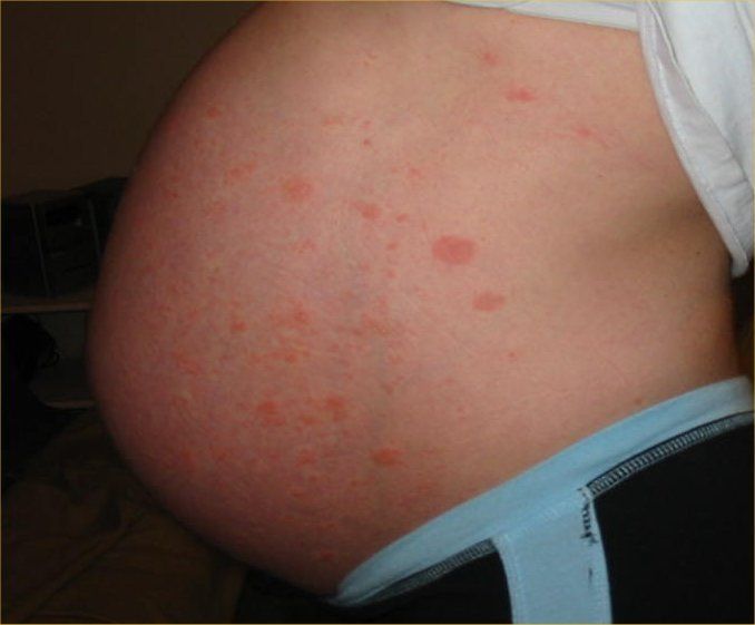 best of Spots pregnancy Facial during
