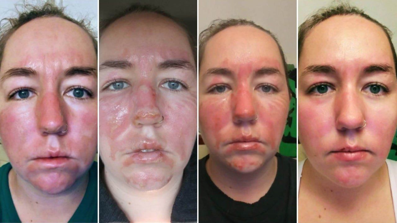 Wonder W. reccomend Cure photo facial burn