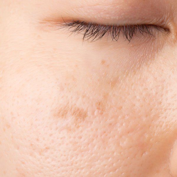 Facial skin blemish