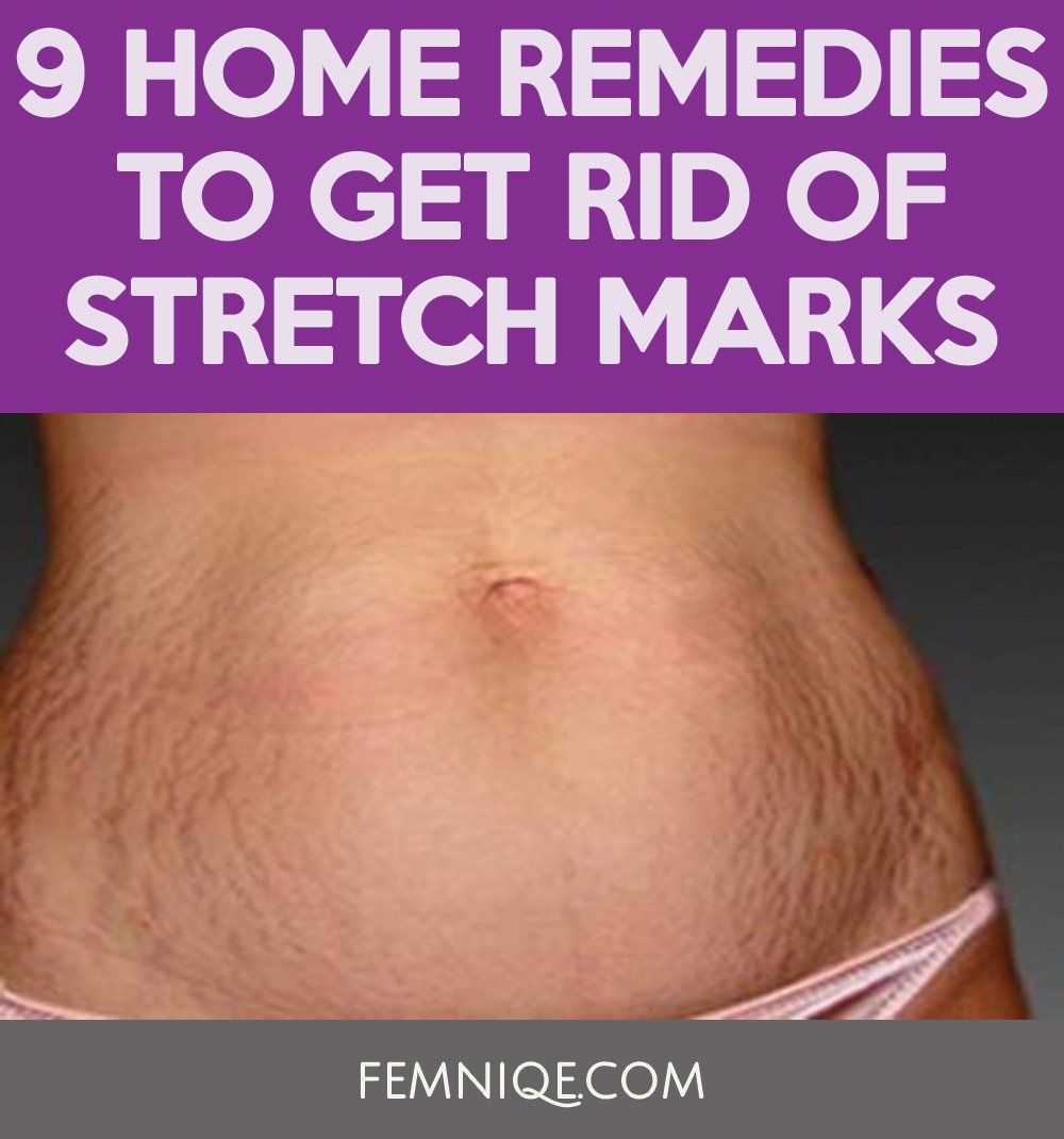 Halfback recomended ass Stretch marks on