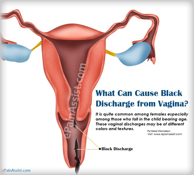best of Discharge vagina Dark