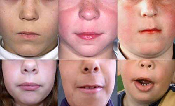 best of Facial syndromes Deafness genetic