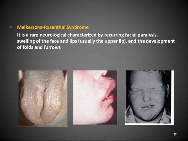 Facial and expression and syndrome