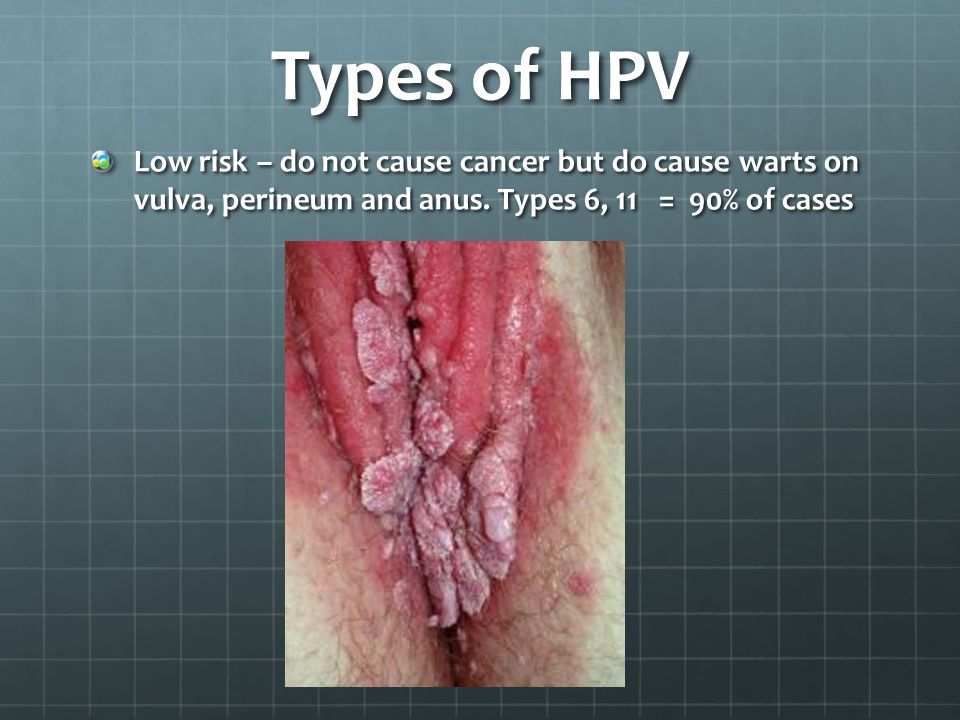 Snickerdoodle reccomend Human papillomavirus vulva