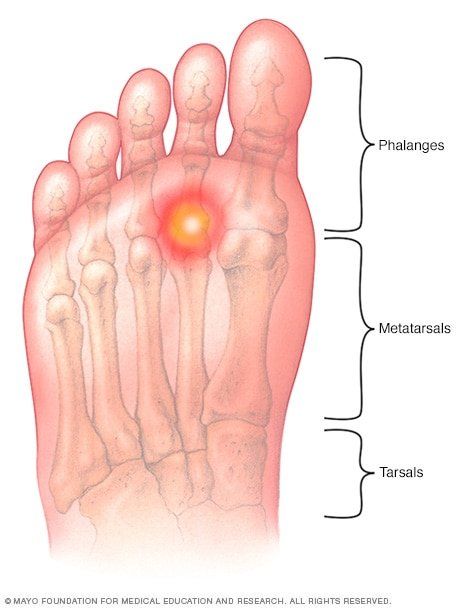 best of Foot bottom Unexplained pain