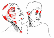 Facial pain trigeminal neuralgia