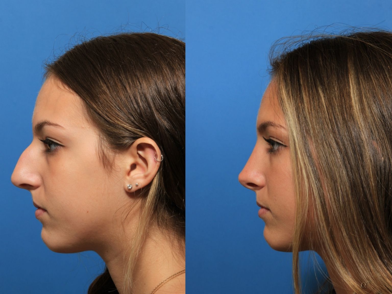 Facial jon m.d plastic reconstructive surgery turk