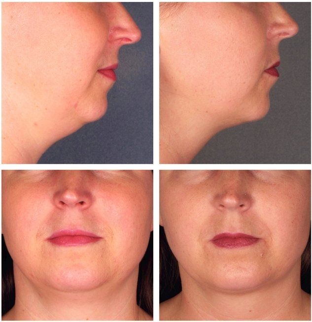 best of Virginia specializing in lip in northern reduction plastic surgeons Facial