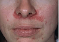 Facial rash around nose