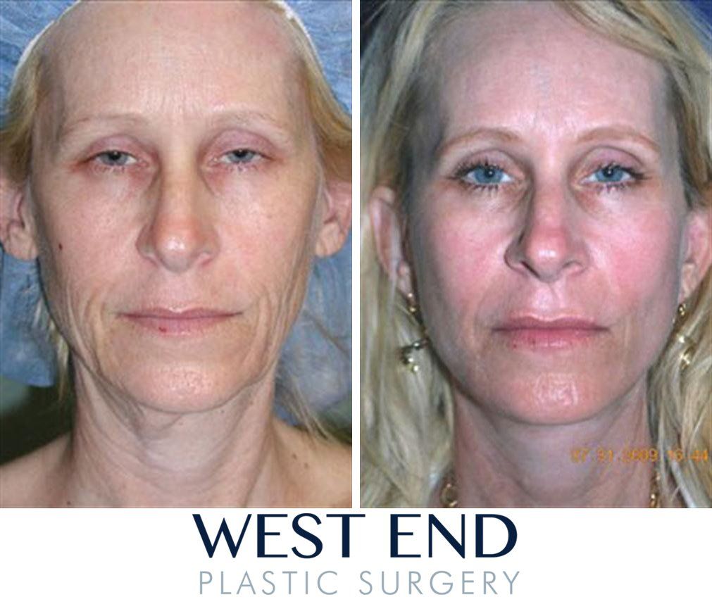 Jelly B. reccomend Facial rejuvenation west virginia Top