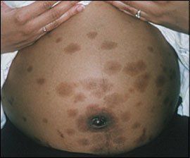 best of Spots pregnancy Facial during