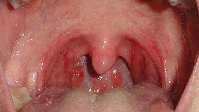 best of Throat strep Can get adults