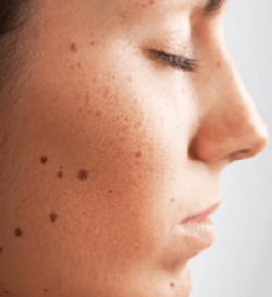 best of Of spots facial rid Getting