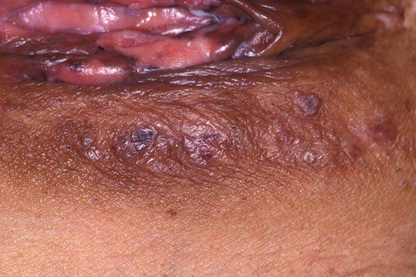 Beamer recommendet Human papillomavirus vulva