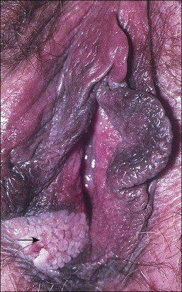 Peanut recommend best of vulva Human papillomavirus