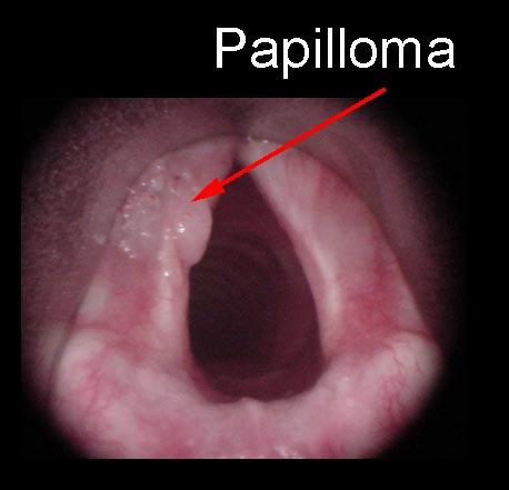 Human papillomavirus vulva