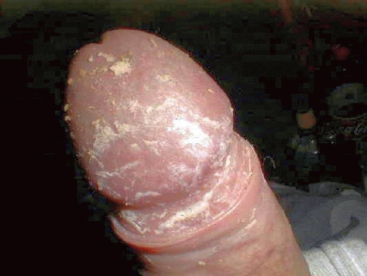 Mens cock cheese Unnatural build-up of smegma (cheese under foreskin)