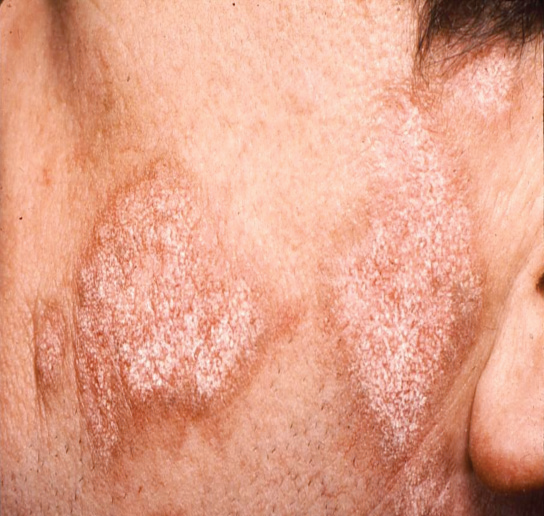 best of Damage rash Nerve facial