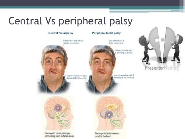 best of Facial nerve Peripheral
