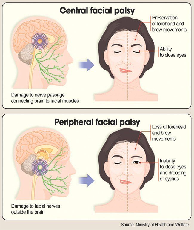 Peripheral facial nerve