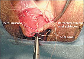 Rectum penetration perineal repair