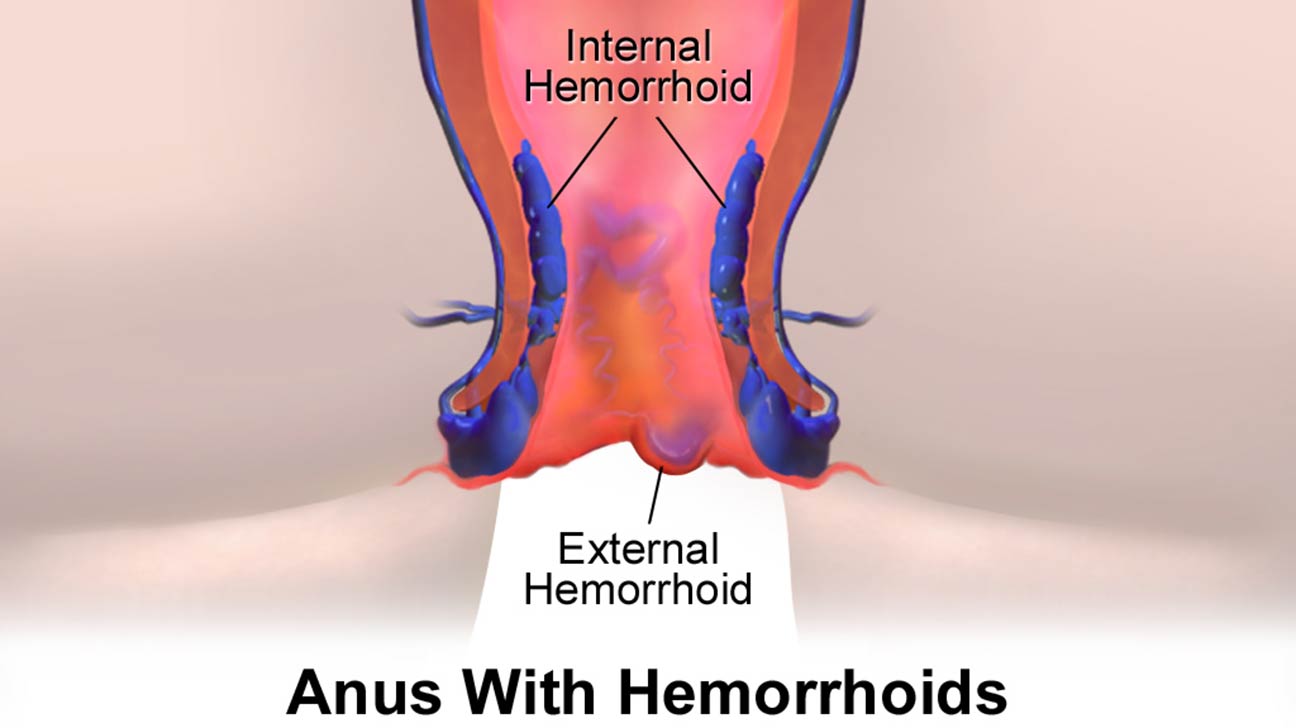 Red anus hemroids bild