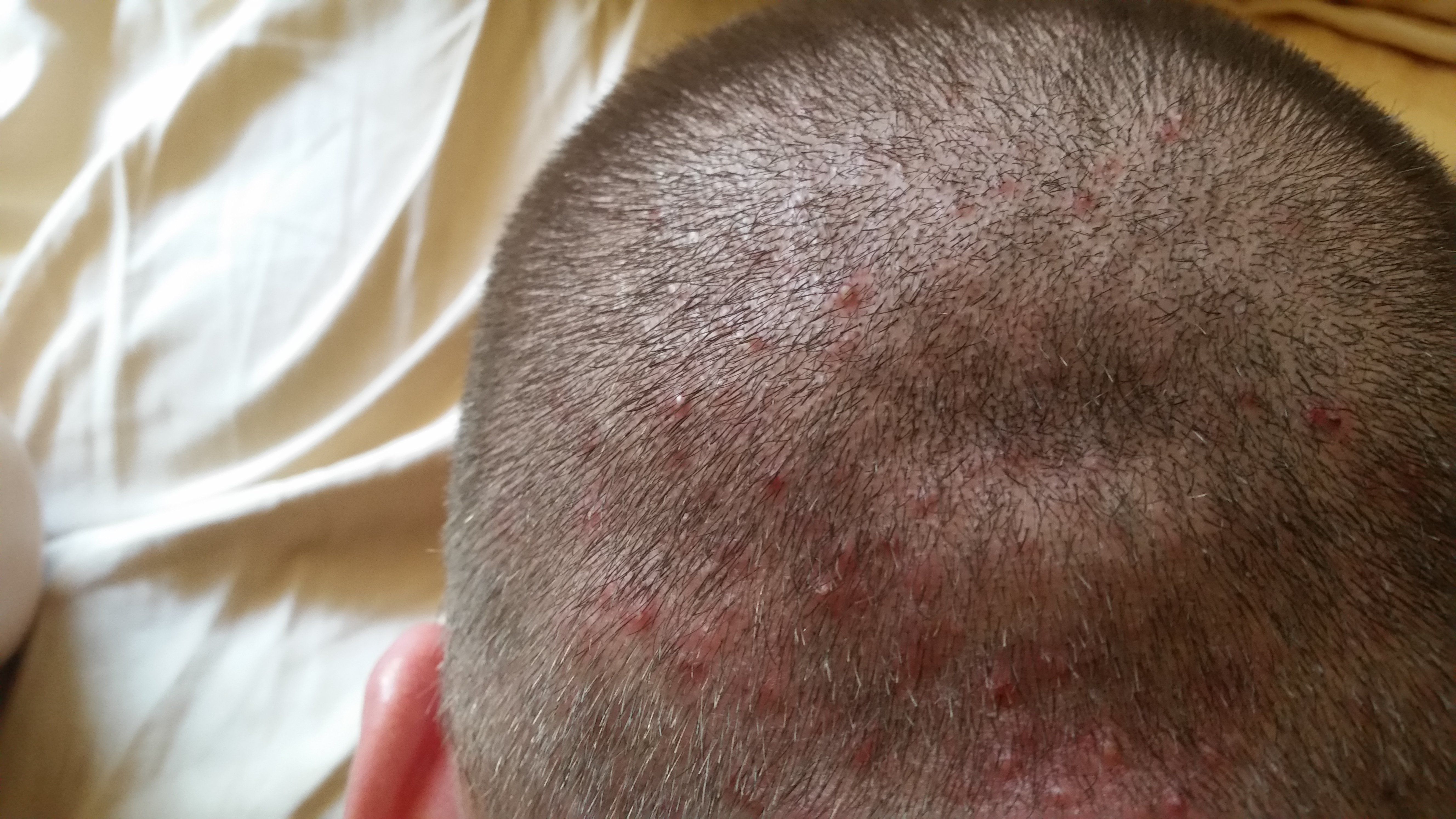 Shaved head cures folliculitis