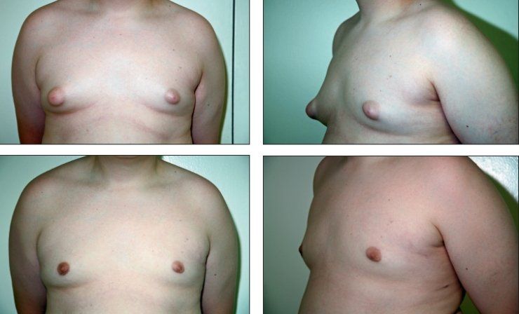 Diesel reccomend Swollen nipples on boys
