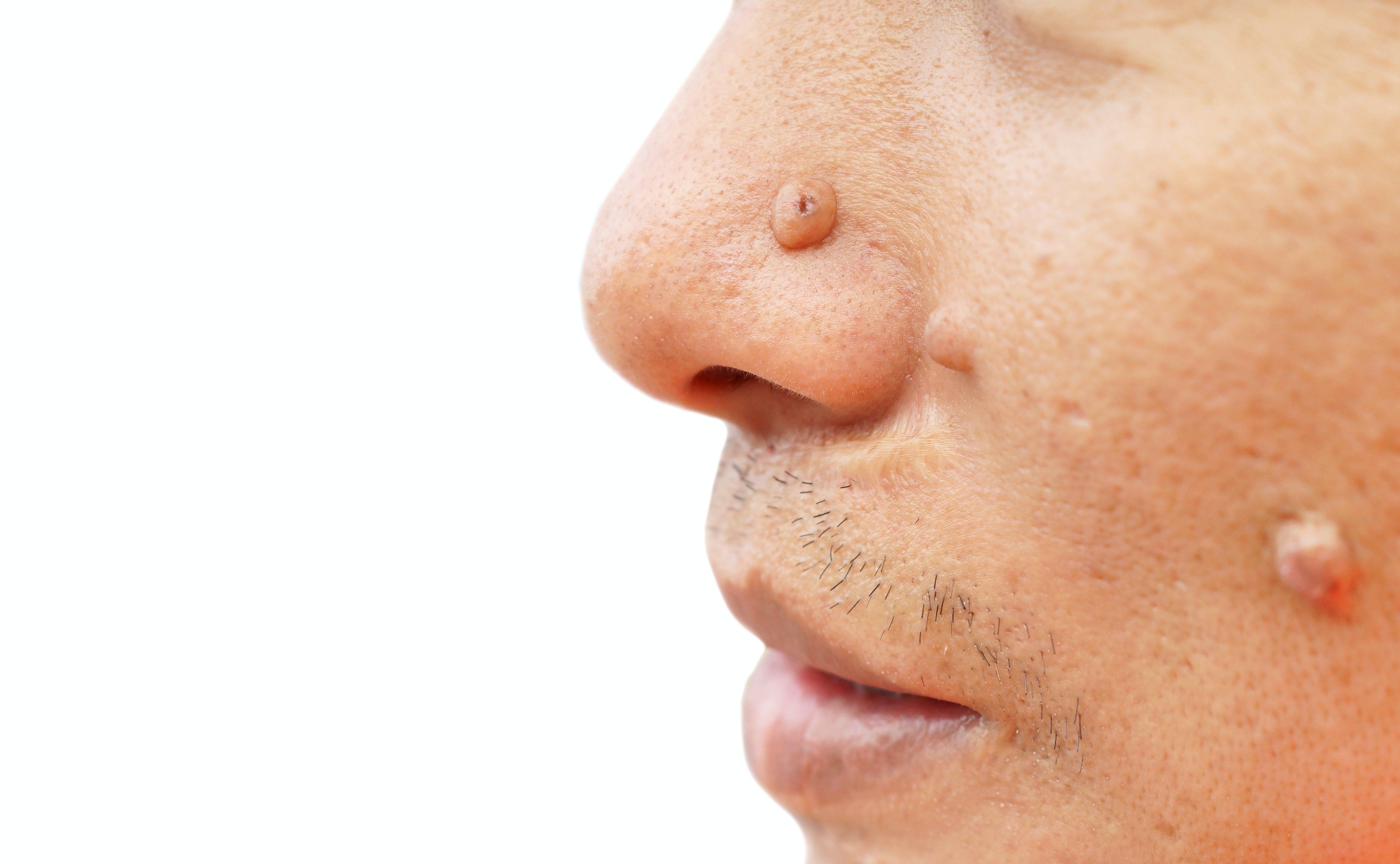 Land M. reccomend Syptoms of facial bump