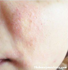 Frostbite reccomend Treatment for facial rash
