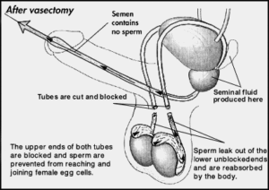 Bootleg recomended leak Vasectomy sperm