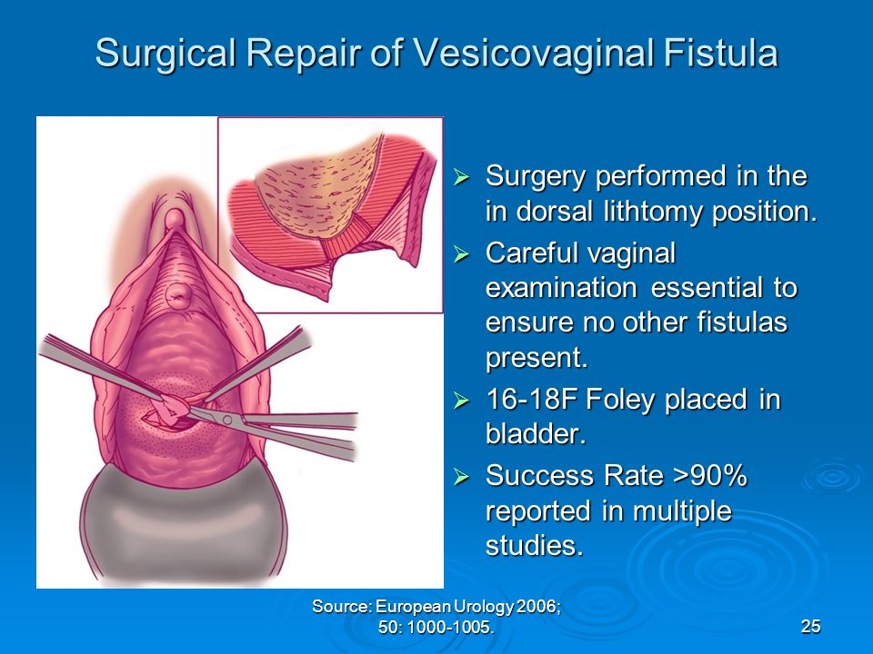 Vesico vaginal fistula pictures