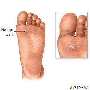 Wart removal bottom of foot
